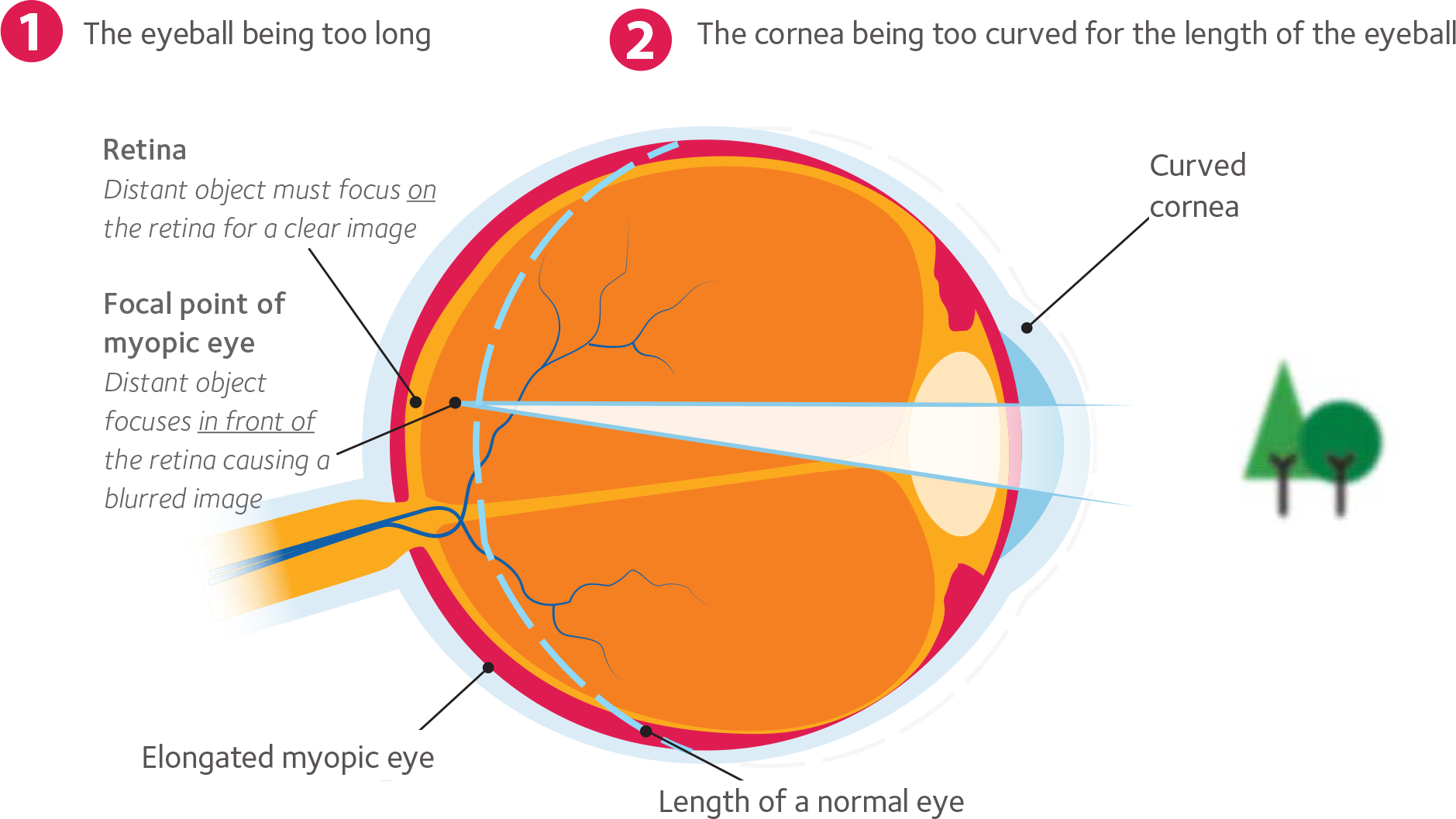 myopia shape of eye explained